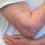 New Targeted Molecular Agents Tailor Psoriasis Treatment