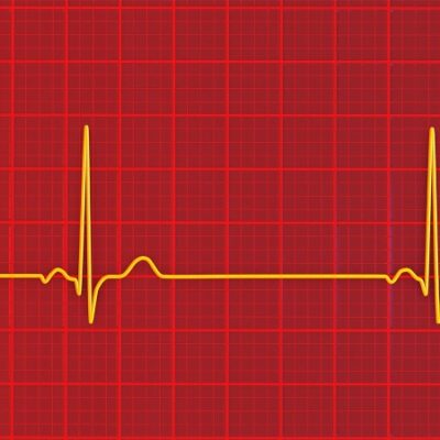 Severe Issues With Slow Heartbeat Flagged for Afib Patients on Antiarrhythmics