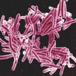 Research study discovers no consistent cough in 4 out of 5 people with tuberculosis in Africa and Asia