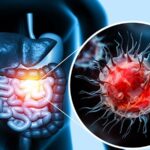 New Data: How Early Colon Cancer Cells Evade Immune System