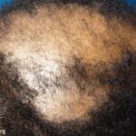 Significant Responses Seen for Cicatricial and Total Hair Loss